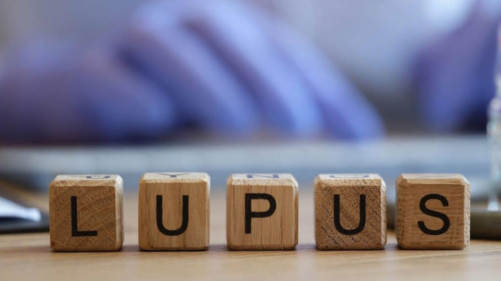 lupus ve beslenme